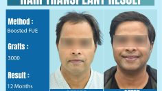 Which Indian City is Ideal for Hair Transplant?