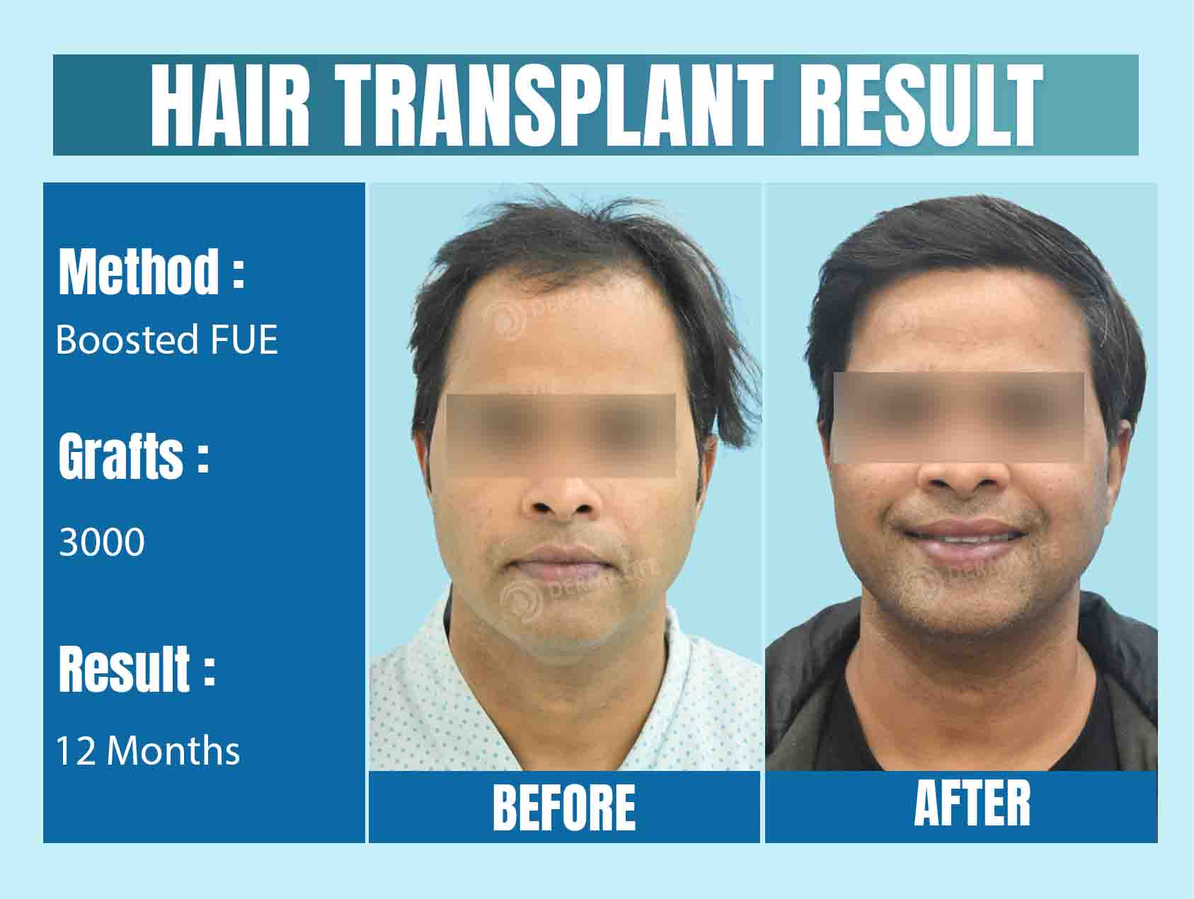 Which Indian City is Ideal for Hair Transplant?